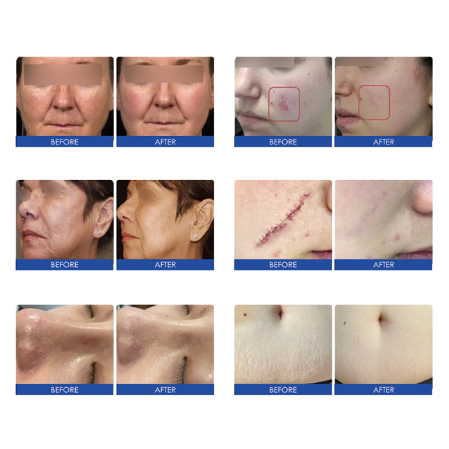 Professional 60W CO2 Fractional Laser Machine – 4-in-1 Skin Resurfacing & Vaginal Tightening System
