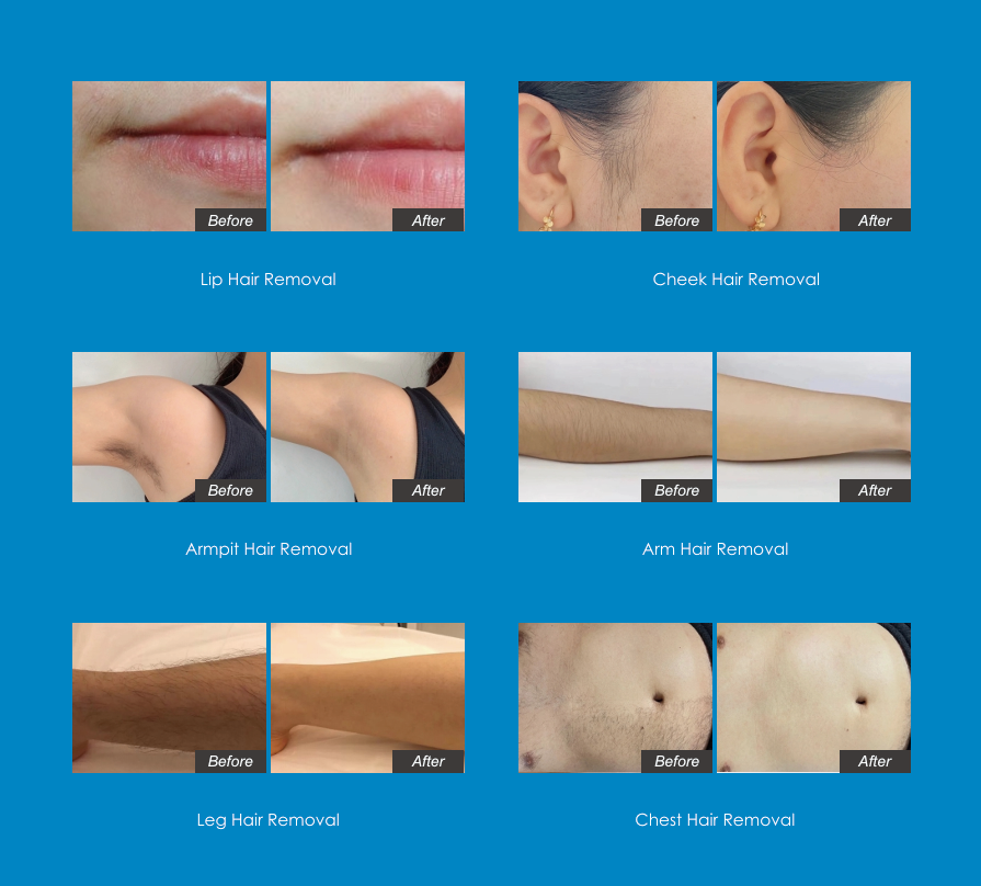 Innovative multi-wave  HAIR REMOVAL PLATFORM