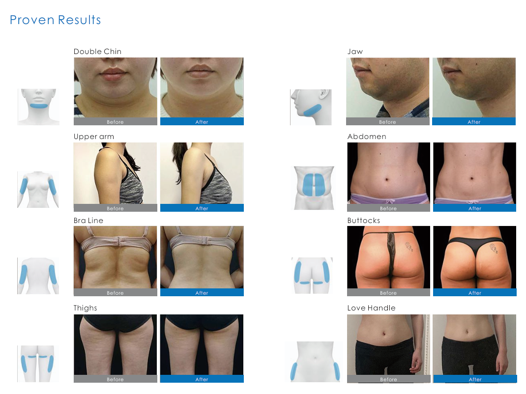 Professional 360° Surround Cooling Cryolipolysis Machine – 4th Gen Multi-Applicator Non-Invasive Fat Freezing Device with 15.6" Android Control System