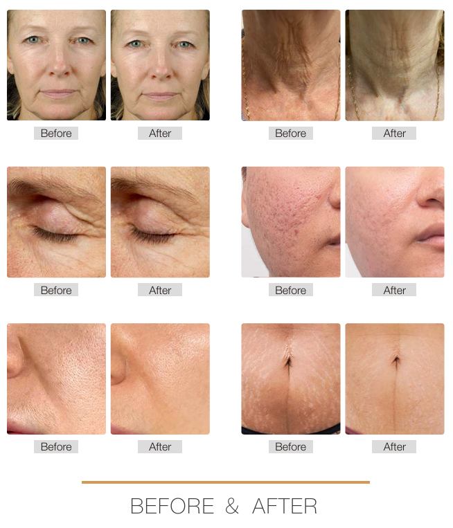 RFM Star™ Professional 3-in-1 Microneedling RF System with Vacuum Suction Technology